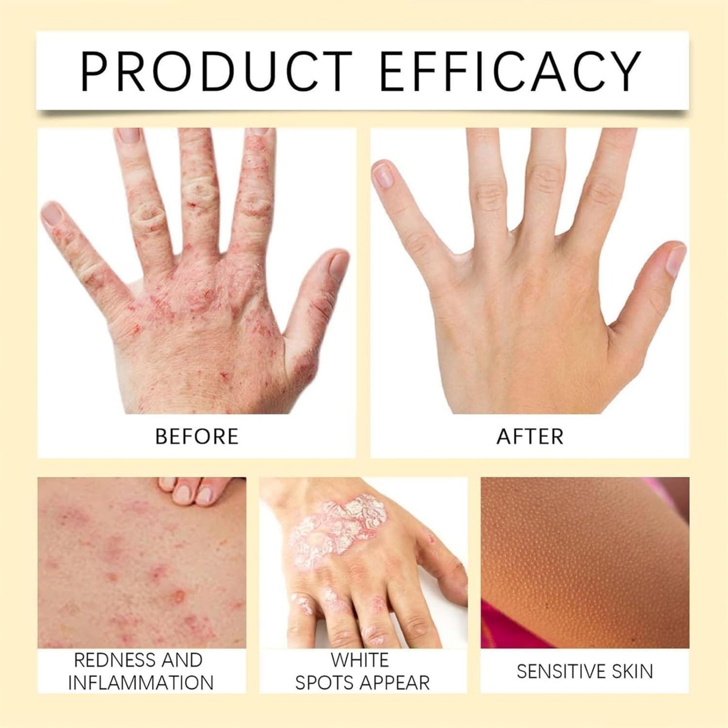 Vitigo Bee Venom Treatment Cream | Natural Skin Repair Hydration Relief Anti-Irritation